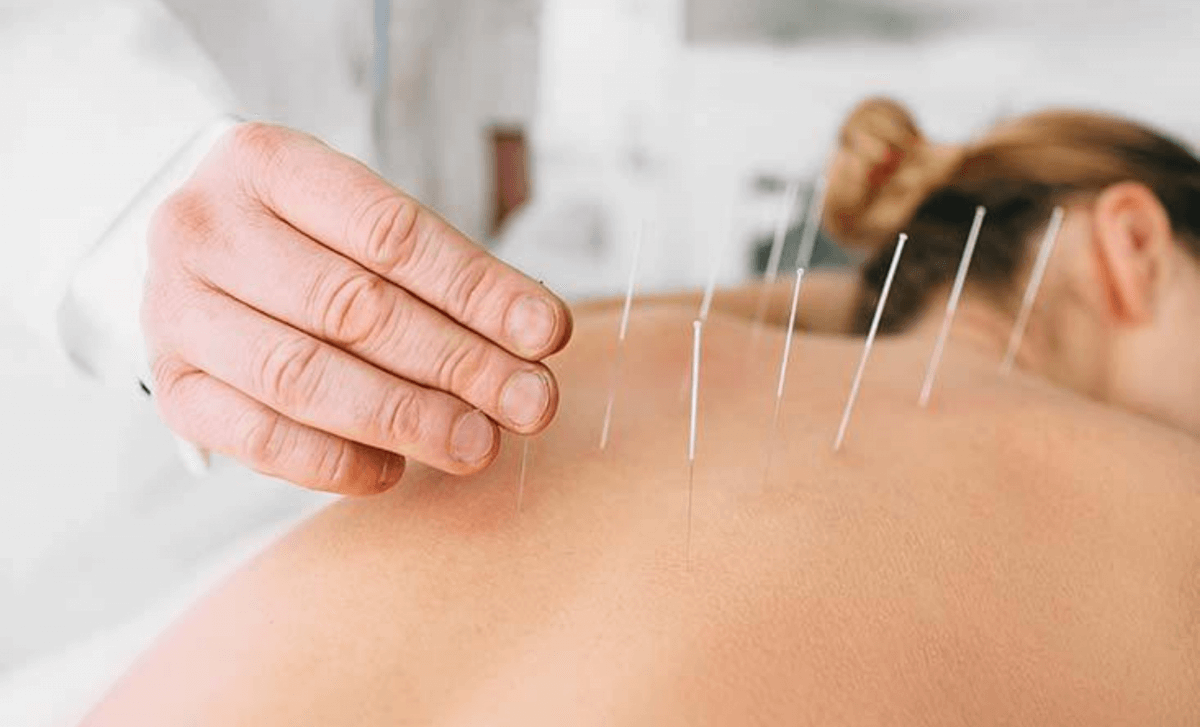 Acupuncture at Home
