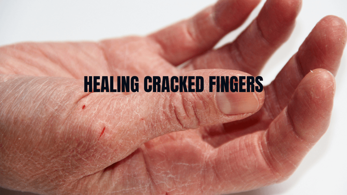 How To Heal Cracked Fingers For Good