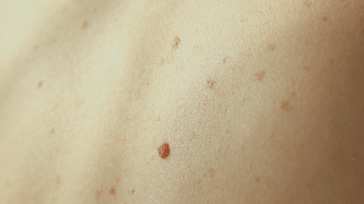 Skin Cancer 101: Basal cell carcinoma, squamous cell carcinoma, and what you need to know