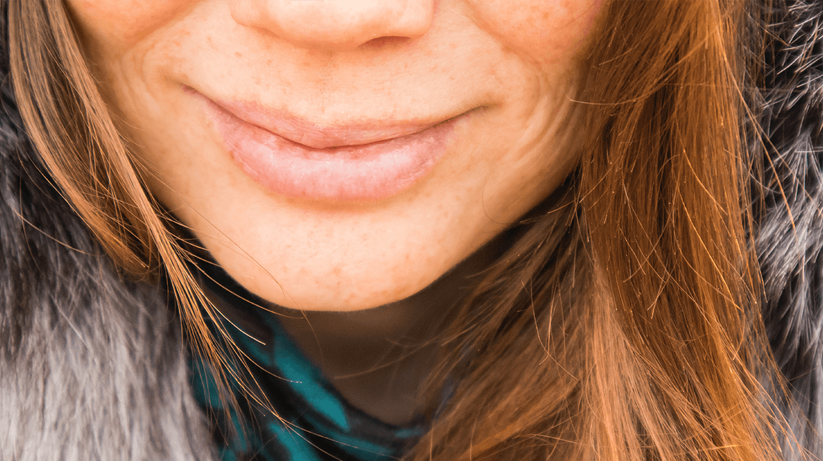 Pickel um den Mund: So behandelst du deinen Hautausschlag am besten