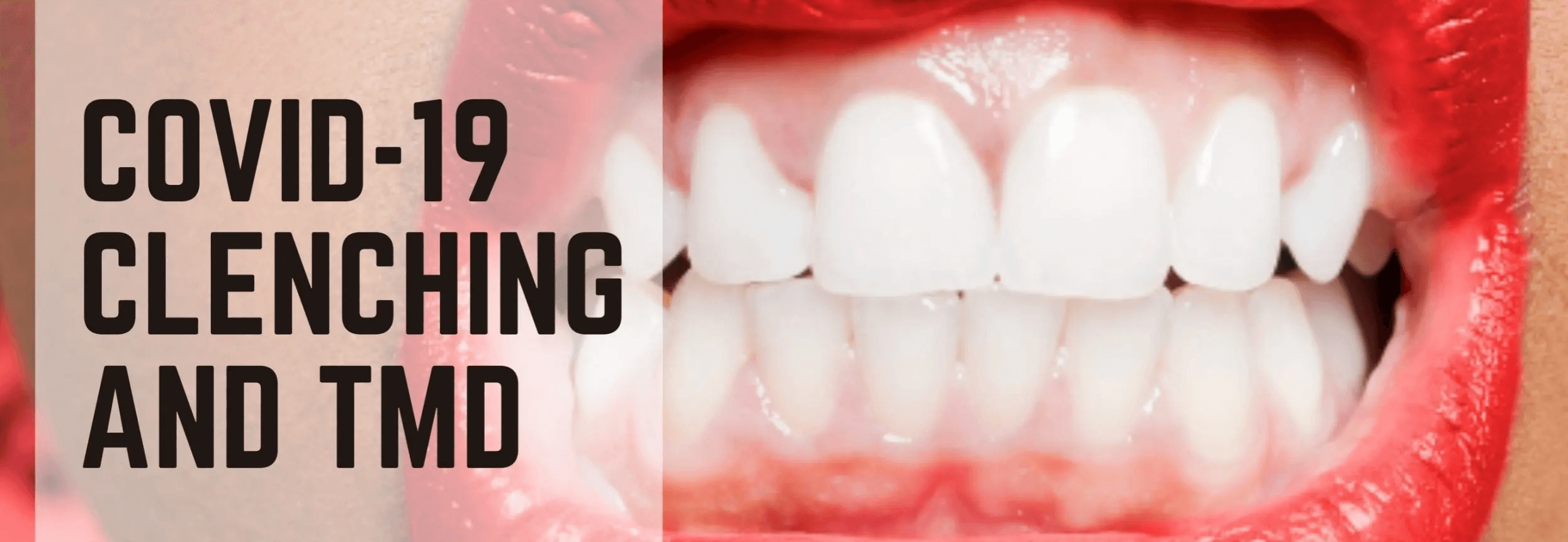 Teeth Grinding & COVID-19: The Increase in Teeth Damage