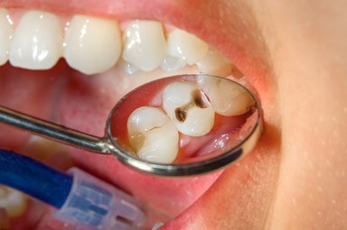 Can Wearing a Night Guard Cause Cavities?
