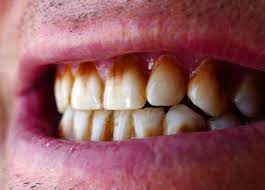 What Causes Discolored Teeth?