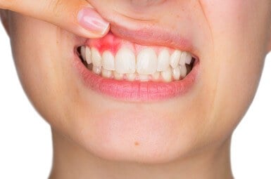 Does Sleeping with a Night Guard Damage Your Gums?