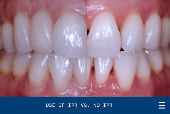 Is IPR Healthy For Your Teeth?
