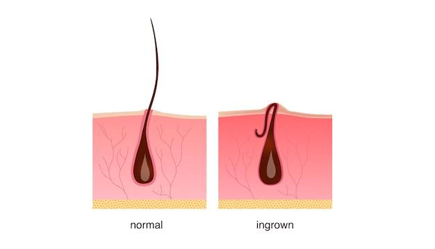Ingrown hair after shaving, cream or epilator.